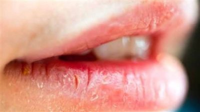 أحذر.. شفتيك المشققة علامة على إصابتك بالأمراض