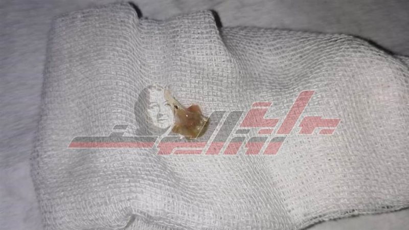 الشوكة التى تم استخراجها