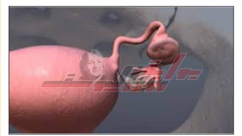 الحمل خارج الرحم