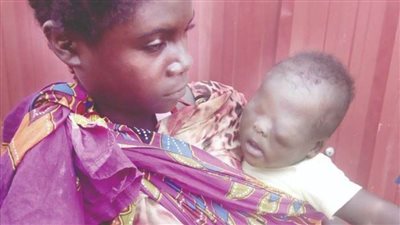 ولد مطمور العينين.. 2 مليون جنيه تجعله يرى النور