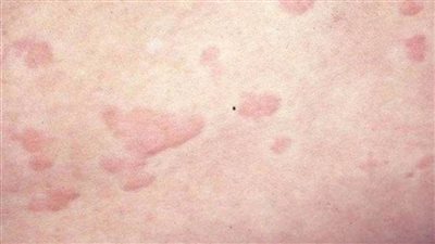 الطفح الجلدى علامة جديدة على الإصابة بفيروس كورونا المستجد 