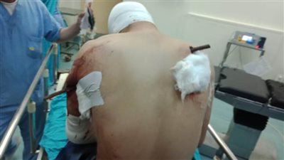 استخراج سيخ حديدي اخترق رئة مواطن 