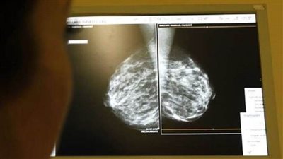 العلماء يحددون البروتين الغامض المسؤول عن سرطان الثدي العدواني