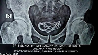 استخراج شاحن موبايل طوله 60 سنتيمترًا من شاب أدخله في قضيبه