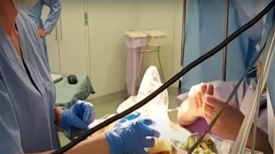 شاهد فيديو يحبس الأنفاس لإيطالية تطبخ أثناء إزالة ورم في المخ!