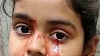 فتاة تذرف دما بدل الدموع في حالة طبية محيرة تربك الأطباء (صورة)