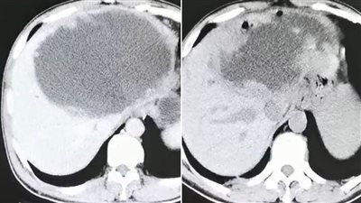 شاهد.. كبد صيني يتحول إلى كتلة مليئة بالديدان لتناوله أسماكا غير مطبوخة جيدا