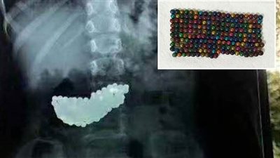 طفلة يابانية تبتلع 190 حبة مغناطيس والأطباء يتدخلون 