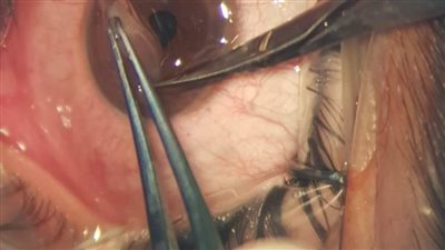 الرعاية الصحية تعيد أمل الإبصار لمريضين بعمليتين لزراعة القرنية