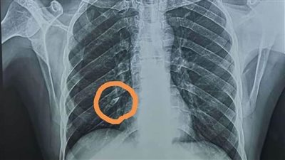 بنها الجامعي تنجح في استخراج 