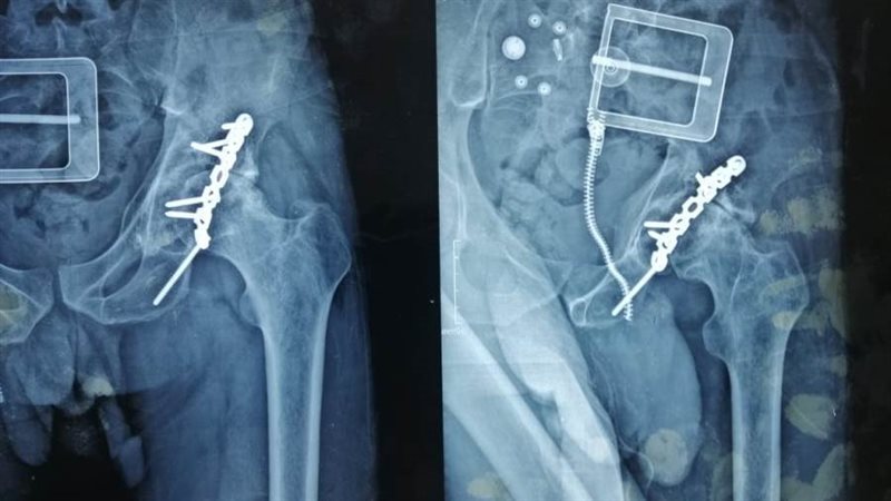 تغيير المفصل