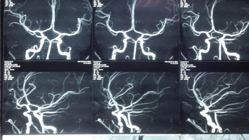 تشخيص الطفلة