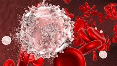 أستاذ أورام يتحدث عن اكتشاف بديل لعلاج سرطان الدم بسعر منخفض (فيديو)