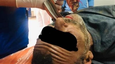 استخراج «سمكة حية» من القصبة الهوائية لصياد ببنى سويف  