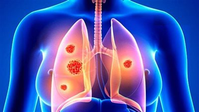 حملة توعية بسرطان الرئة لتمكين المرضى وأفراد المجتمع