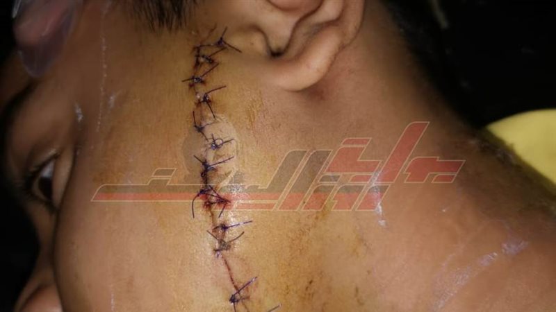 الطفل المصاب ب36