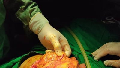 أطباء المنيرة ينقذون مريضة ثقب معوي.. ويؤكدون: حالة خطرة