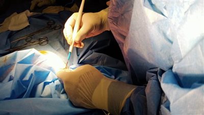 عمليتان جراحيتان لاستئصال أورام بالثدي بمستشفى فاقوس