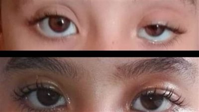 إجراء 175 جراحة عيون بالدقهلية خلال ديسمبر الجاري