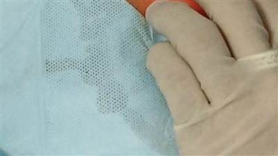 تركيب أنبوبة تغذية معدية بالمنظار لطفل 7 سنوات بمستشفى التضامن ببورسعيد