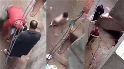 جامعة المنصورة تتبنى علاج الطفلة المعذبة على يد والدها بنبروه