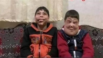 13 عامًا من التنمر.. شقيقان يعانيان من مرض نادر بالدقهلية