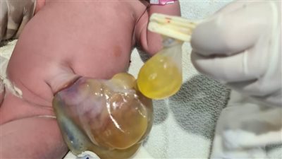 عيوب القلب الخلقية المصاحبة لحالات عيوب جدران البطن تكون لها أسباب موسمية