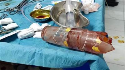 استخراج كوبين زجاجيين من أمعاء مريض بالمنصورة