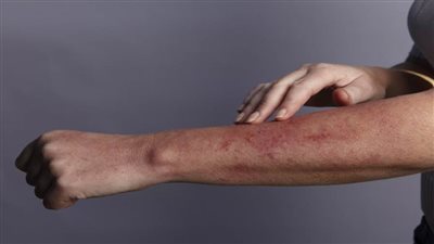 امرأة تُصاب بالتهابات غريبة 