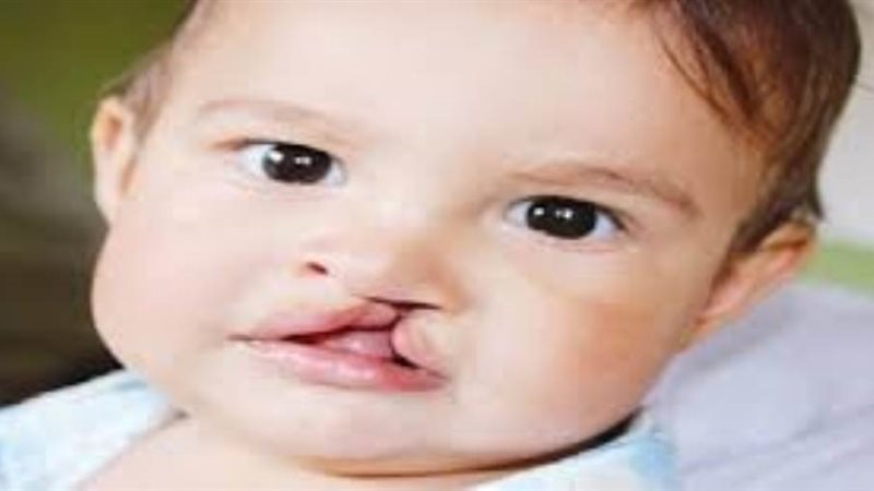 الشفة الأرنبية