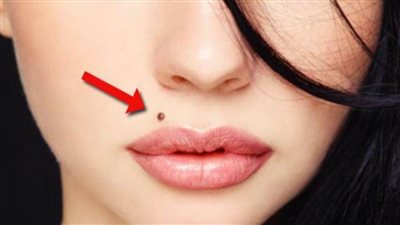 متى تتحول الشامة لخلايا سرطانية؟.. استشاري جلدية يجيب