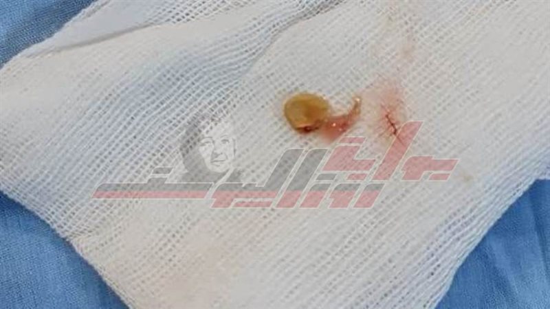 العملية التي أنقذت