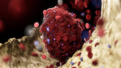 علامات لجلطة دموية قد تبدو مشابهة للشدّ العضلي!