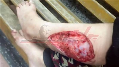 كلب ضال يأكل قدم طفل بالخصوص