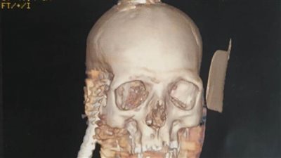 فريق طبي بجامعة أسيوط ينجح فى  استخراج سيخ حديد من جمجمة شاب