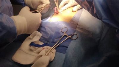 إنقاذ حياة طفلة مصابة بفيروس كورونا تعاني من انفجار الزائدة بسوهاج