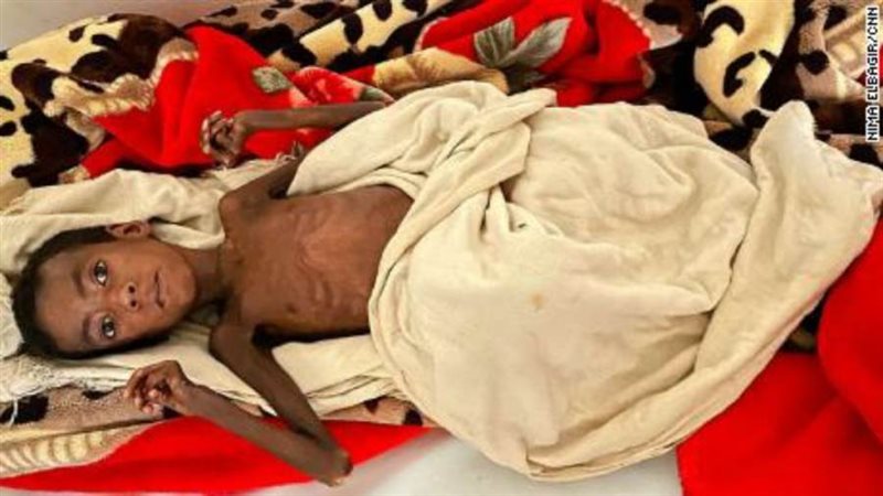 الجوع يفتك بالأطفال