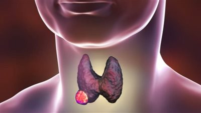 ما هي علامات الإصابة بسرطان الغدة الدرقية وهل يمكن علاج المرض؟