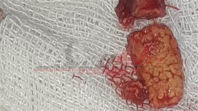 بنها الجامعي تنجح في استئصال حصوة لمريض بقناة الغدة اللعابية