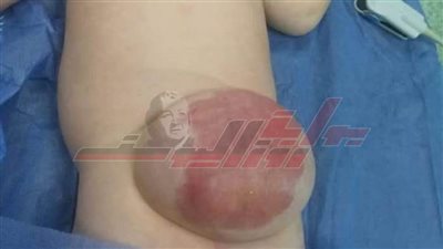 الأطفال التخصصي ببنها ينجح فى استئصال ورم لطفل حديث الولادة