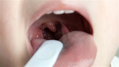  استشاري: وقف علاج اللوز قبل انتهاء مدته يؤدي لمشاكل بصمام القلب