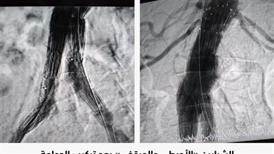 الرعاية الصحية تعلن نجاح أول عملية علاج الصمام الأورطي بتقنية CERAB بالأقصر
