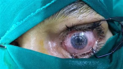 الفريق الطبي برمد المنيا ينجح في إجراء عمليتين جراحيتين  لزراعة قرنية كاملة 