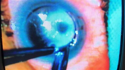 محافظ المنيا يشيد بنجاح عمليتين لزرع القرنية ضمن المبادرة الرئاسية «القضاء على قوائم الانتظار» 