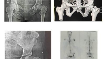 إجراء جراحة صعبة وخطيرة في مستشفى بئر العبد  