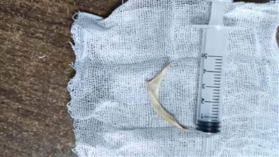 فريق طبي بمستشفيات جامعة أسوان ينجح في استخراج جسم غريب من مريء مريض