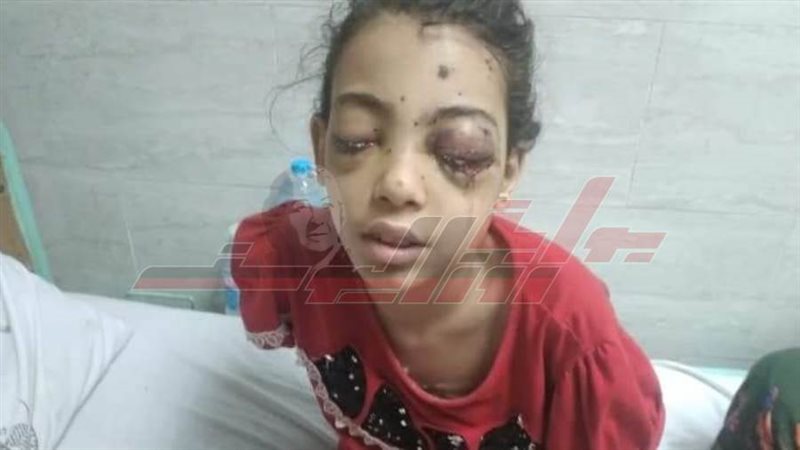 الطفلة المصابة