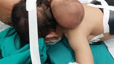 عاجل| أطباء ملوي التخصصي ينجحون في إجراء عملية نادرة بالمخ لرضيع