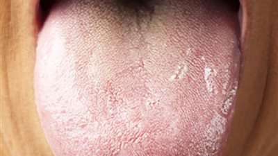 اللسان يمكن أن يكشف عن نقص معدن هام في الجسم