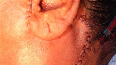 الصحة.. مستشفى القاهرة الجديدة ينجح في استئصال أورام غدية ونكافية لمريضين